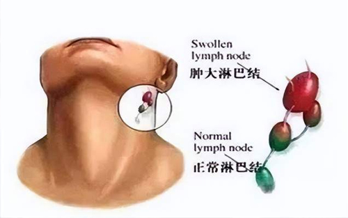 肿瘤淋巴转移