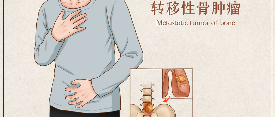 摄图网_401866611_转移性骨肿瘤医疗插画(企业商用) (1).jpg